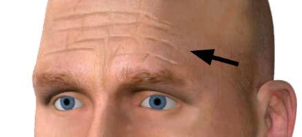 Antlitzdiagnose: Stirnfalten weisen auf Leberprobleme hin