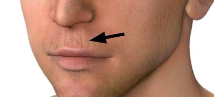Antlitzdiagnose: Lippenfalten stehen oft im Zusammenhang mit Magenproblemen