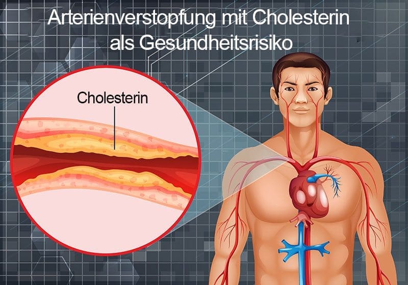Arterienverstopfung durch Cholesterin als Gesundheitsrisiko
