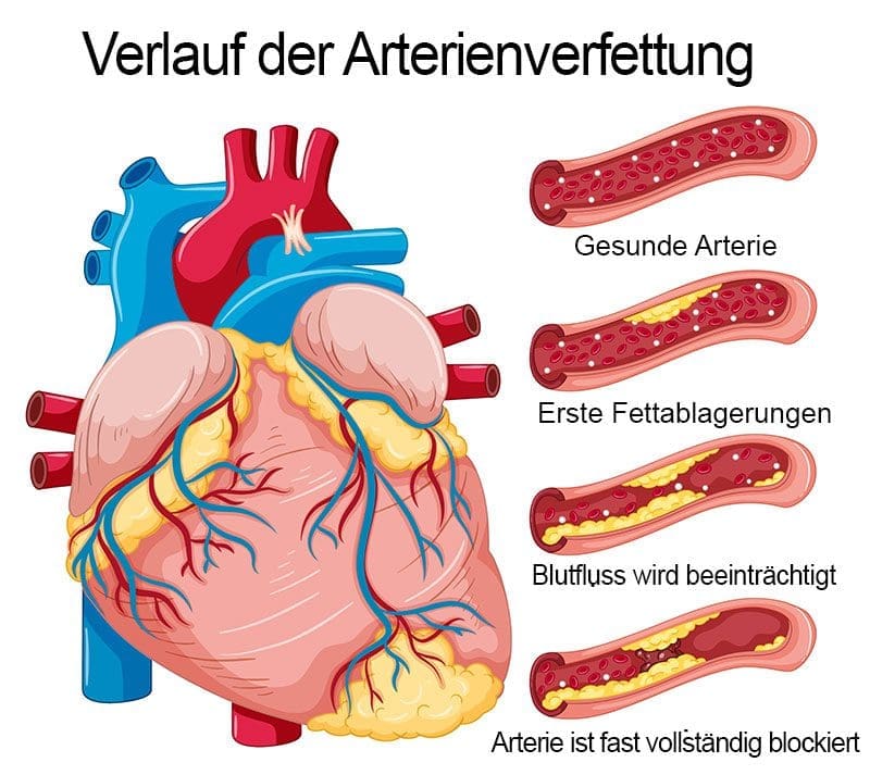 Verlauf einer Arterienverfettung